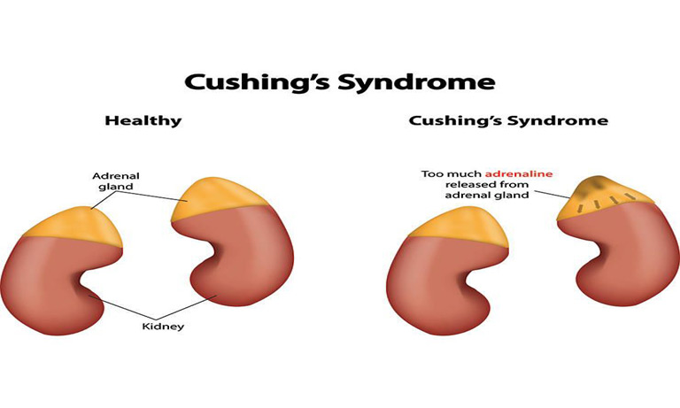 Cushing’s Syndrome