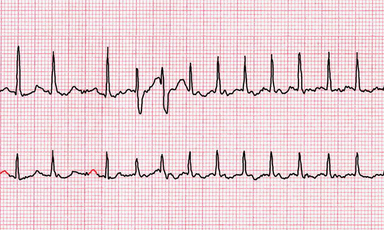 Irregular Heartbeat